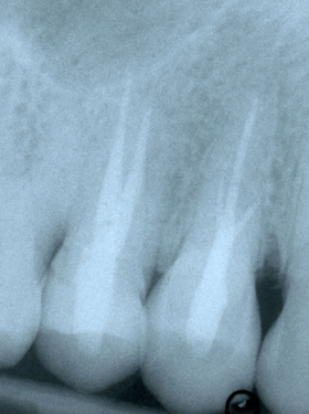 Healing & bicuspid with 3 canals